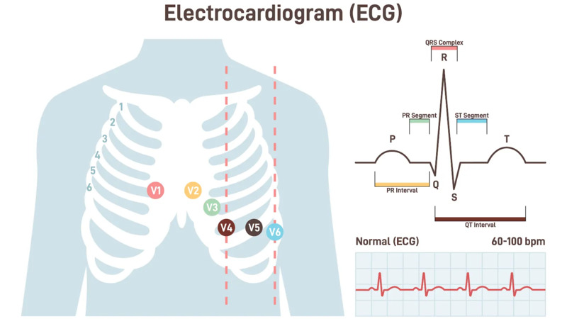 12 Lead Electrocardiogram ECG Medbridge
