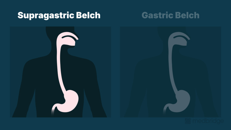 Esophageal Dysphagia Part 4: Belching and Rumination Disorders